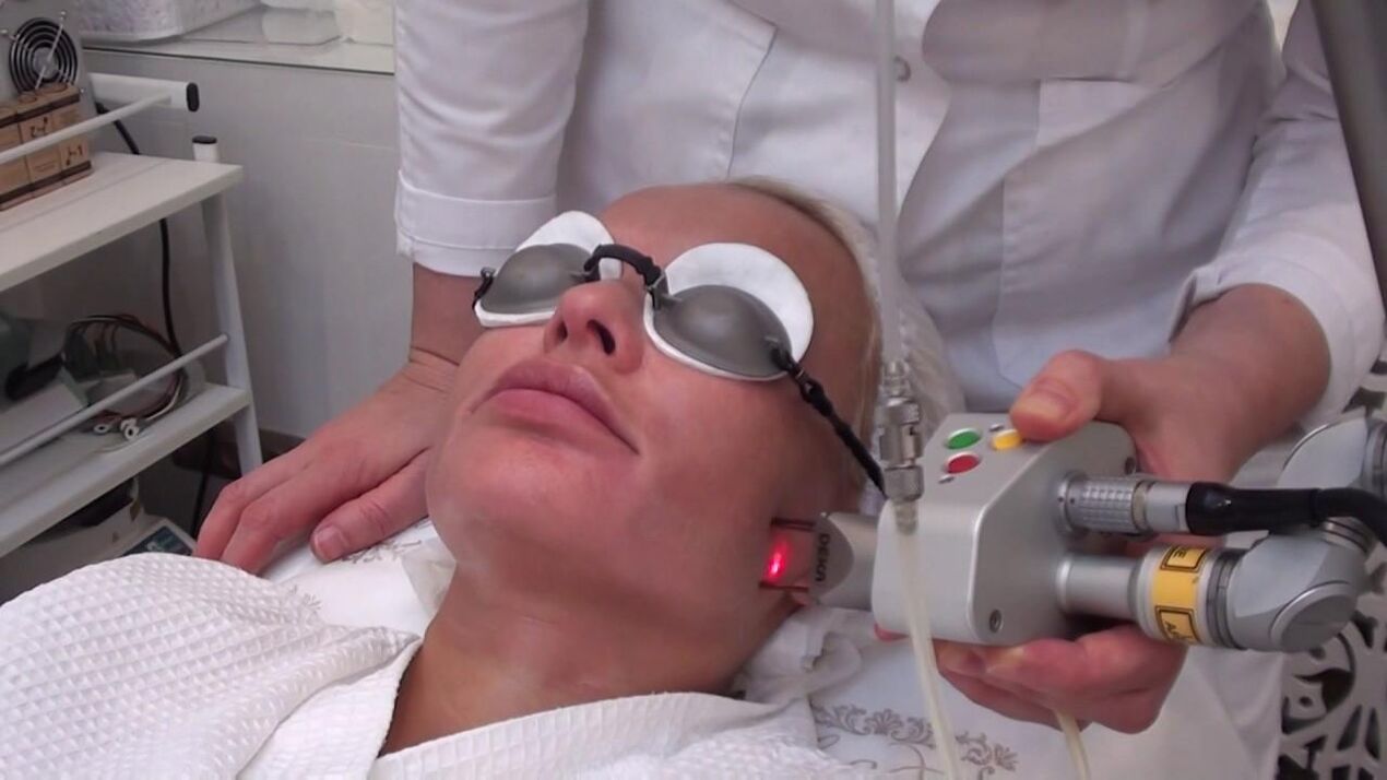 Behandling med en laserstråle av problemområder i ansiktet