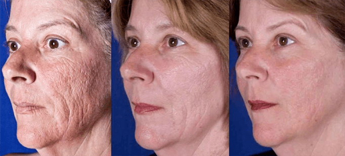 Resultat etter laser ansikts hudforyngelsesprosedyre