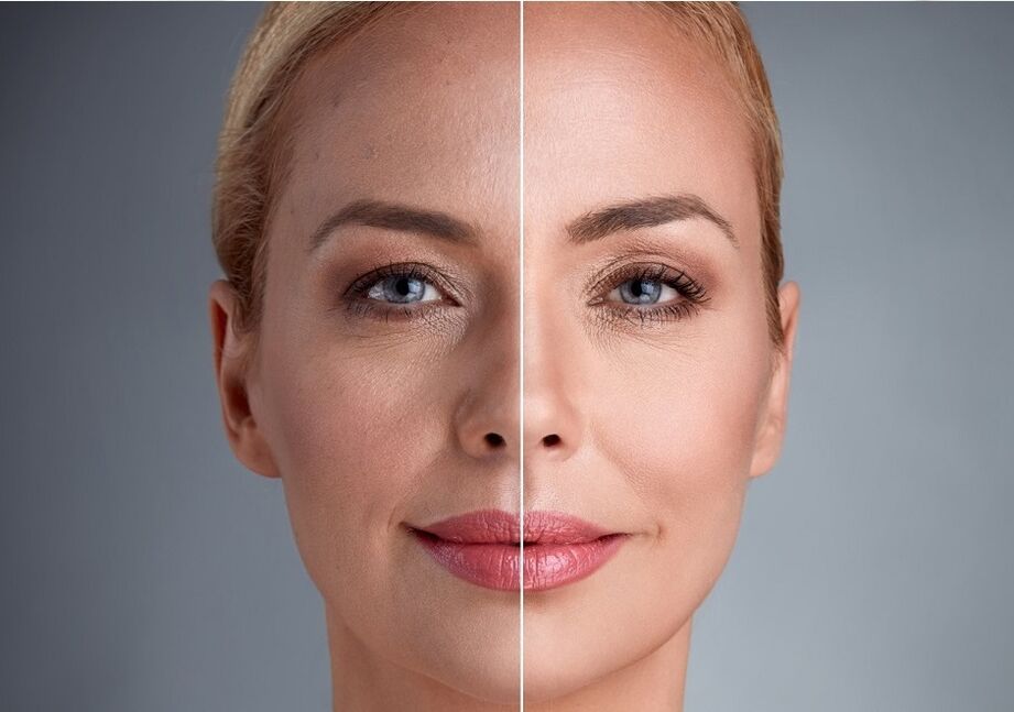 før og etter laser ansiktsforyngelse